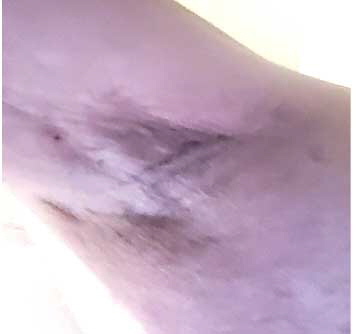 LEFT ARMPIT SEPT 14 LEFT ARMPIT SEPT 14