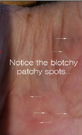 rash1bPALM2 rash1bPALM2