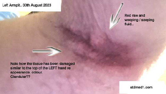 LeftArmpit1